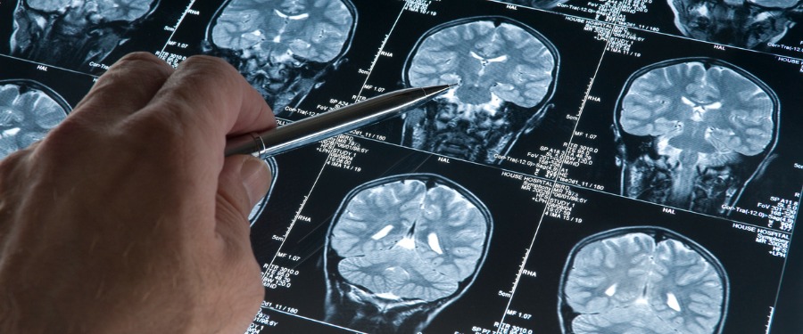 Doctor examining brain scans of Alzheimer’s patient